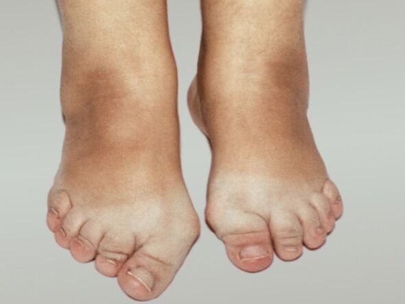 Arthrose des Fußes mit starker Verformung der Zehen