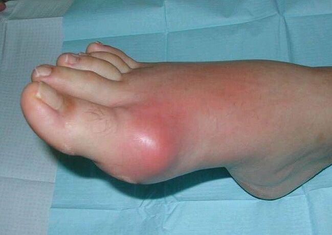 Klinisches Bild einer Fußarthritis mit Schwellung und Entzündung
