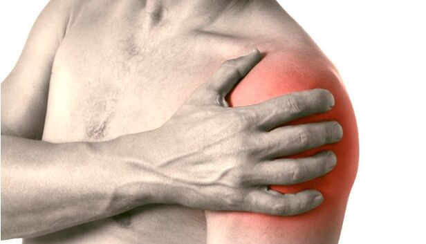 Eine geschwollene, rote und vergrößerte Schulter – Symptome einer Arthrose des Schultergelenks Grad 2-3