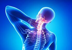 Anzeichen einer zervikalen Osteochondose