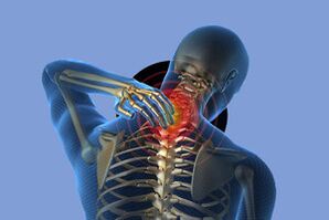 Symptome der Hals -Osteochondose