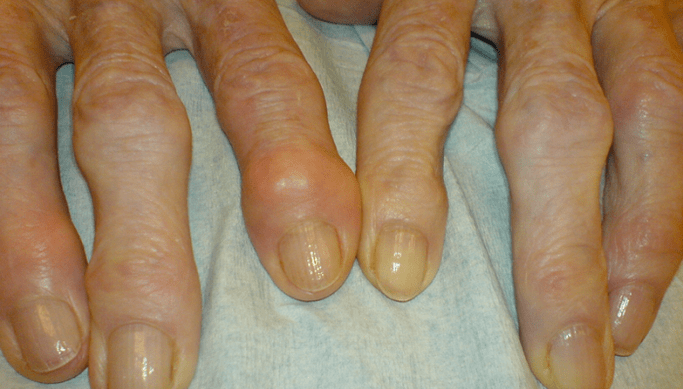 Fingergelenkschmerzen bei Arthrose