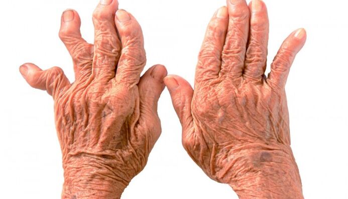 rheumatoide Arthritis als Ursache für Fingergelenkschmerzen