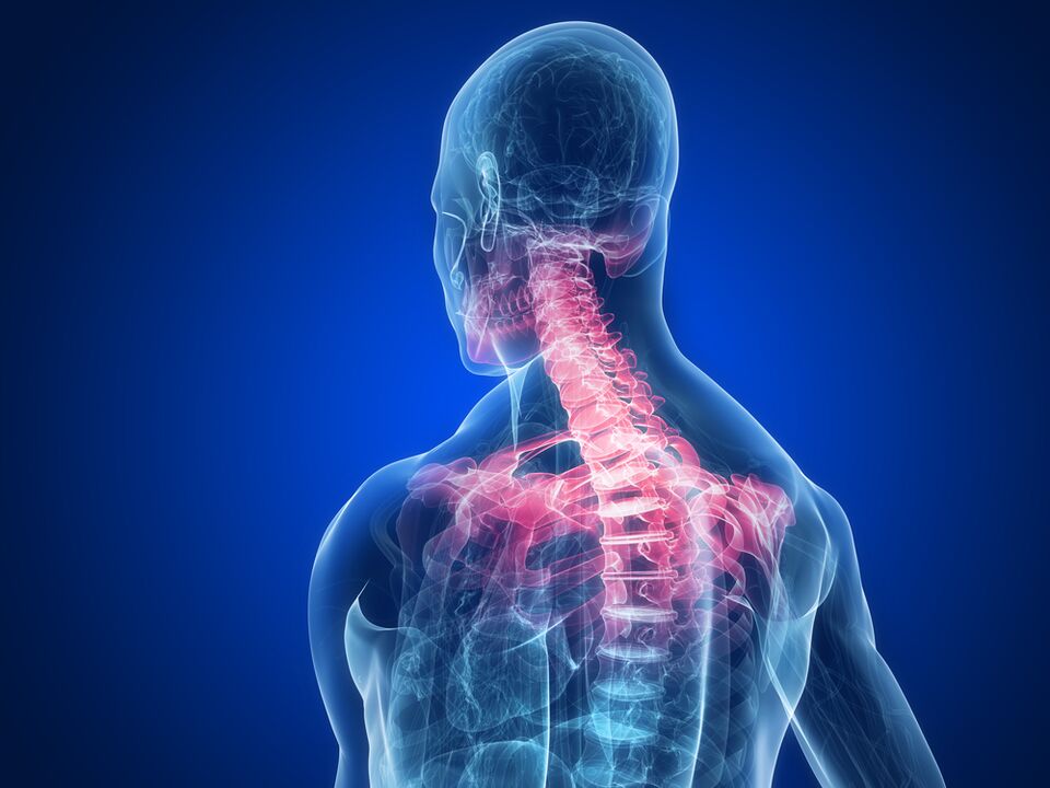Spondyloarthrose als Ursache für Schmerzen zwischen den Schulterblättern