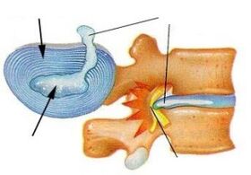 Zerstörung des Faserrings bei zervikaler Osteochondrose