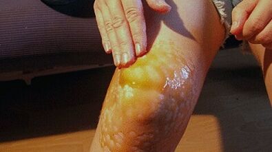 Reiben für die Behandlung der Arthrose des Kniegelenks