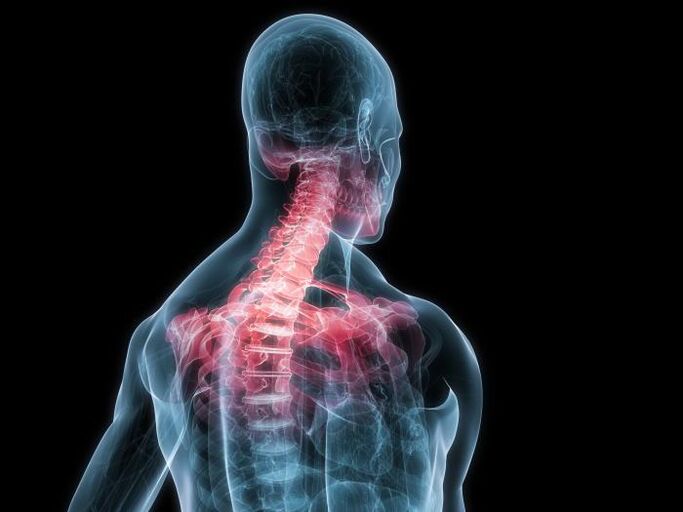 Die Osteochondrose der Halswirbelsäule ist eine Modifikation der Bandscheiben