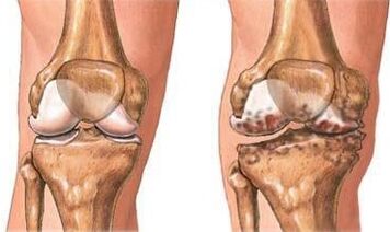 Osteoarthritis des Knies